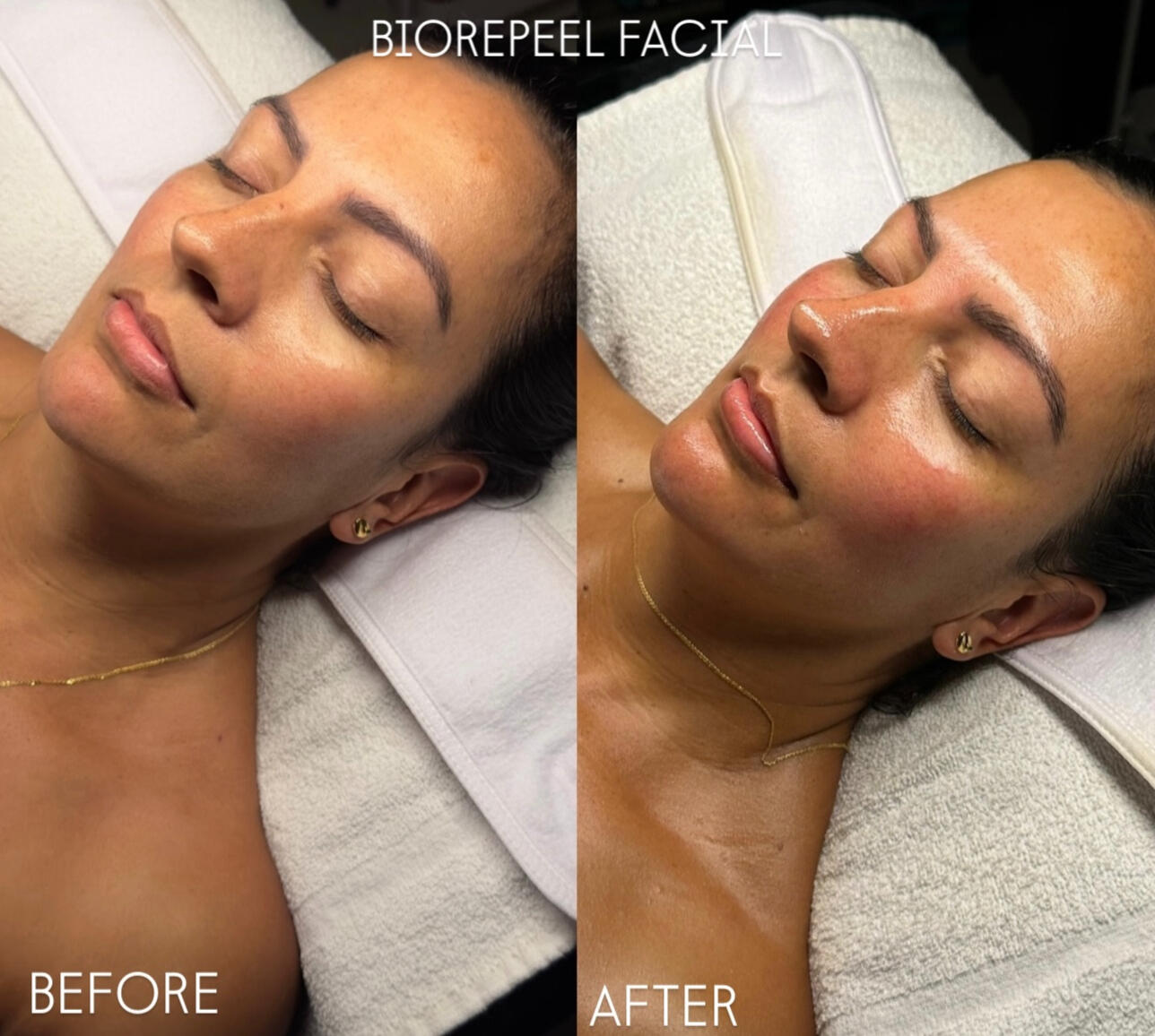 Post BioRePeel Zero Downtime Glow