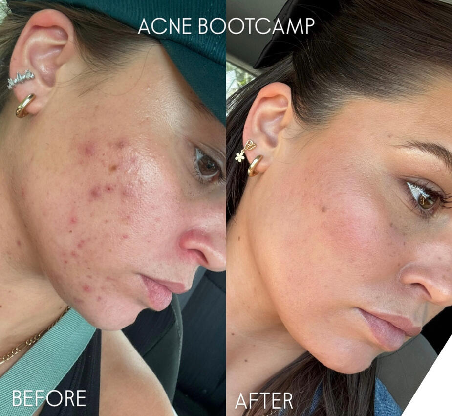 Acne bootcamp transformation Acne bootcamp transformation