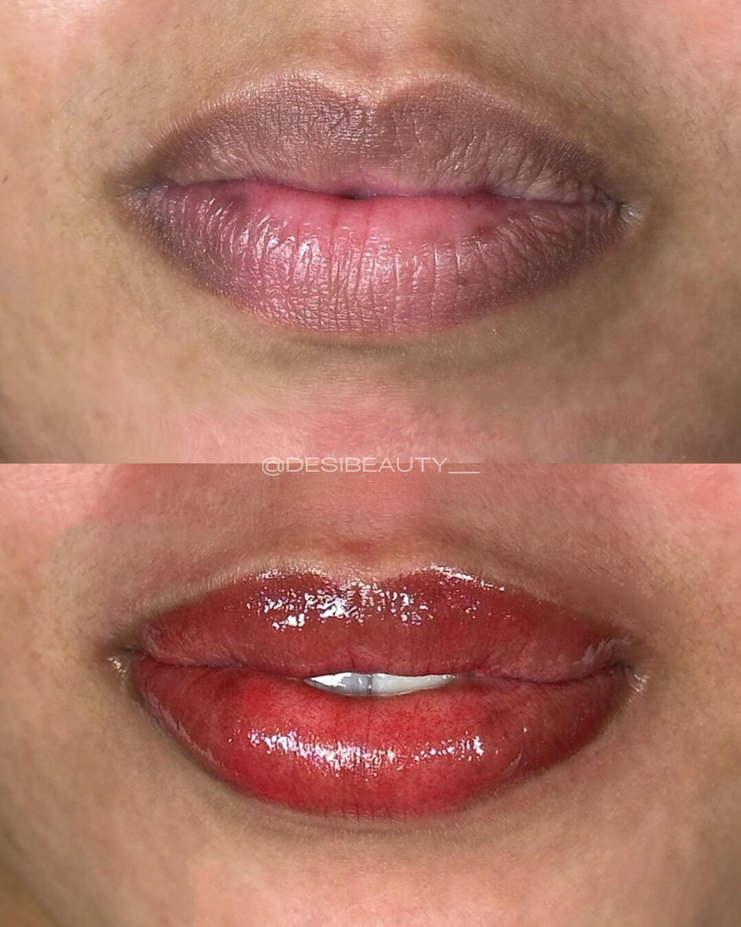 Dark Lip Neutralization