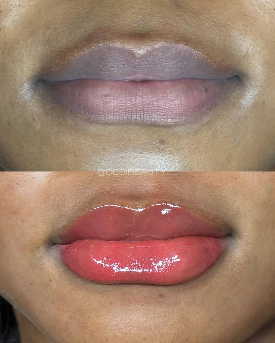 Dark Lip Neutralization